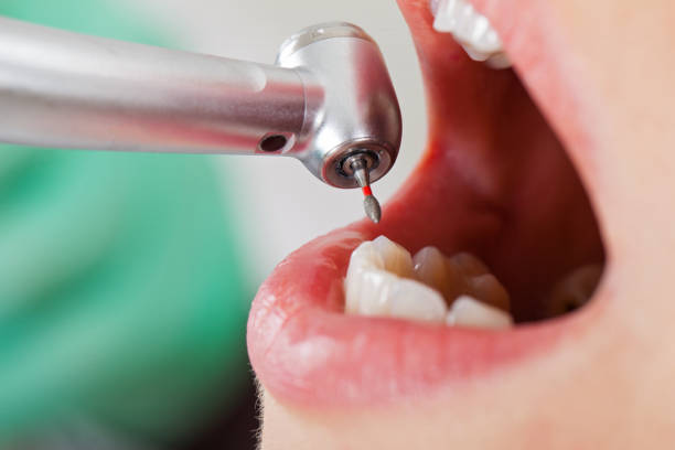 Best Emergency Dentist for Knocked-Out Tooth in Cahokia, IL